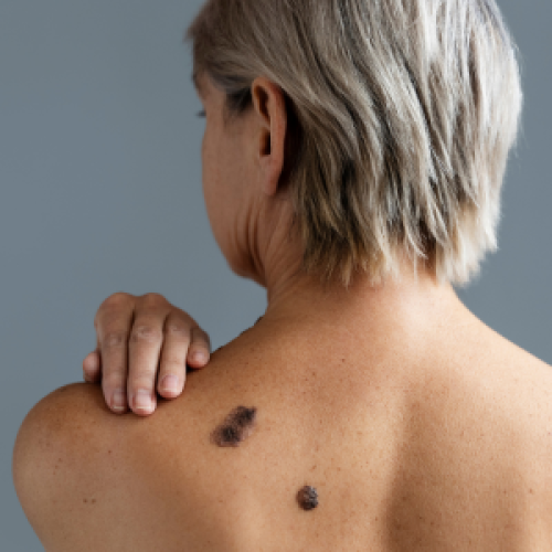 Câncer de Pele – Tipos, sinais de alerta e prevenção